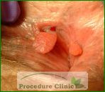 sphincterotomy